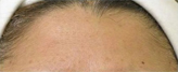 Patient # 41529 After Photo # 2